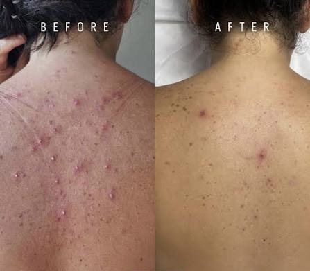 Enzymatic Back Treatment