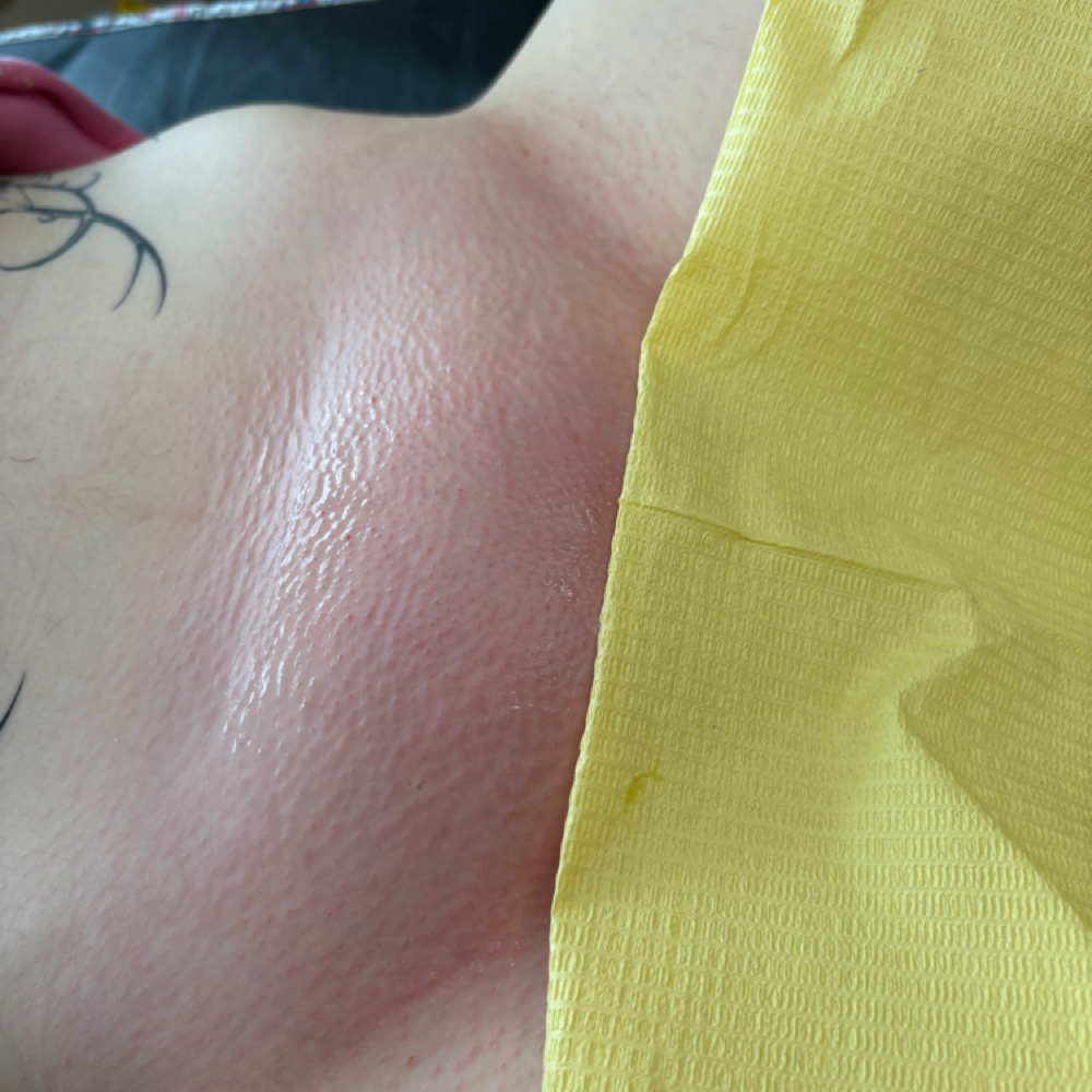 Bikini Full at 5StarEsthetics in Minneapolis, MN