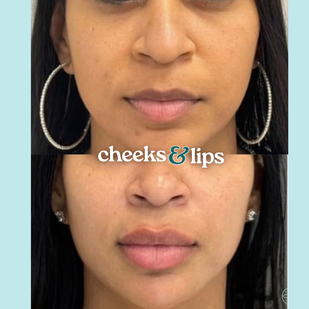 Lip Filler