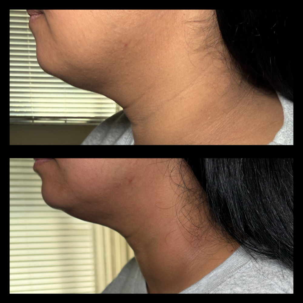 Face Lift/Chin Lift - Noninvasive at Snatched Theory in Sanford, FL