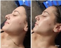 Dermaplaning