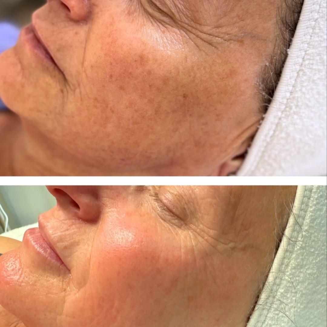 Bio Micro-Needling + Red Light at Bio Skin Aesthetics in Boise, ID