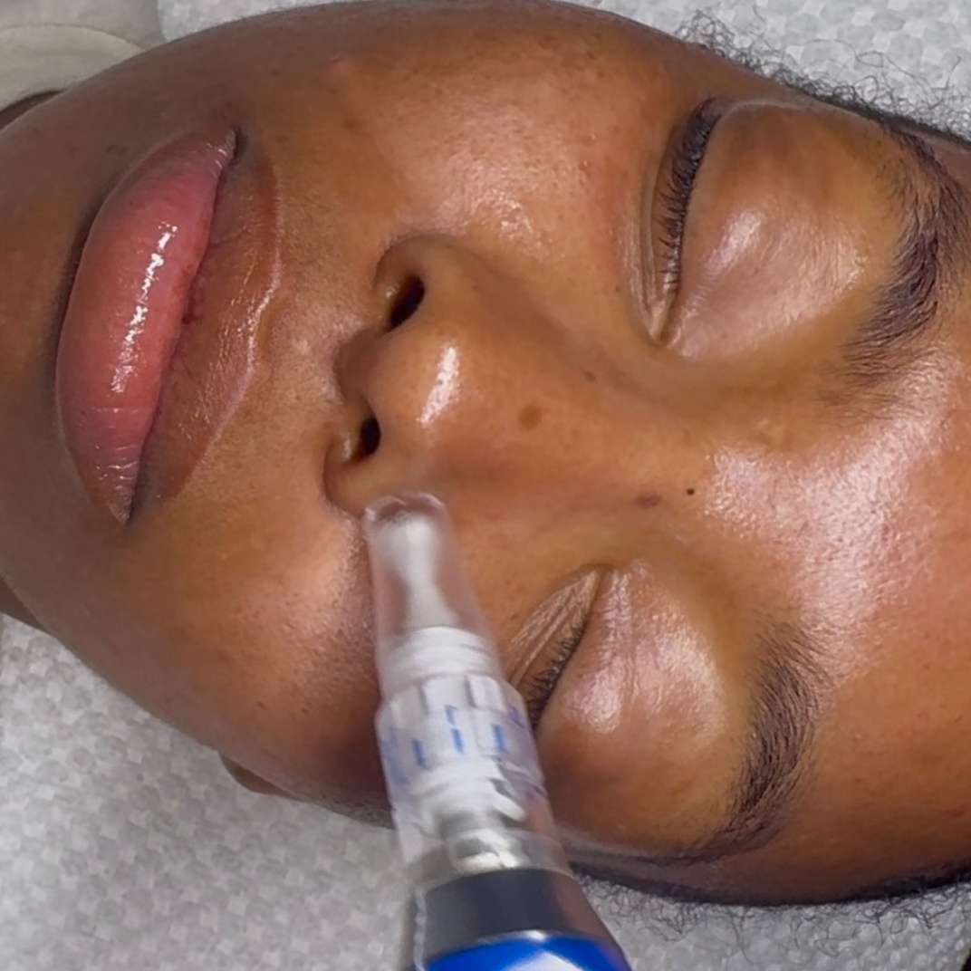 SkinPen Microneedling at Skyn 32 Aesthetics Studio in Dallas, TX