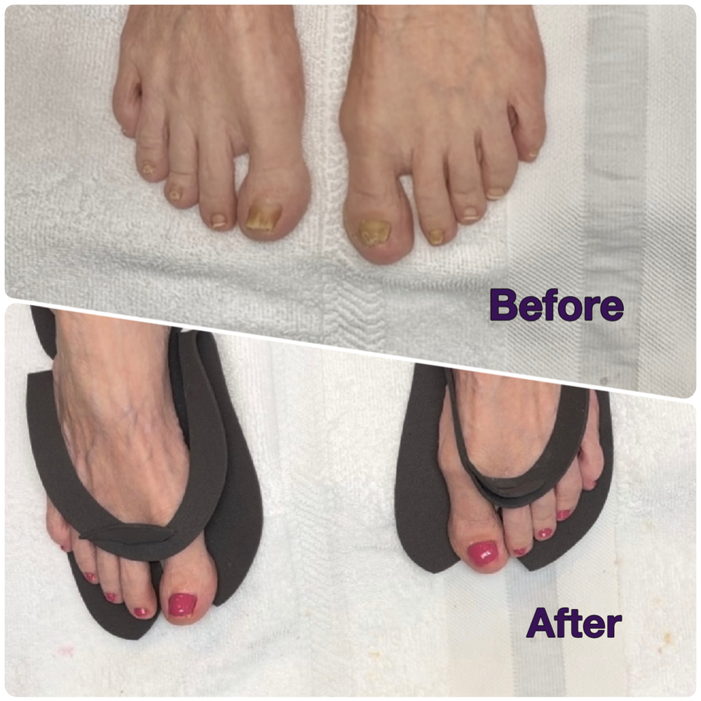 Toenail Restoration at The Painted Lady Nail Salon in Burlington, NC