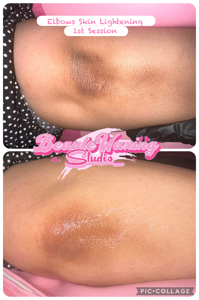 Elbow Or Knees Skin Lightening
