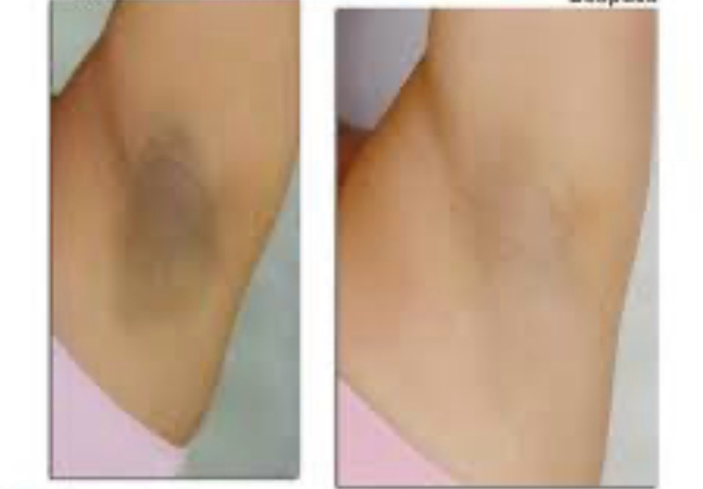 Underarm  Whitening at Merry Spa in Huntington, NY