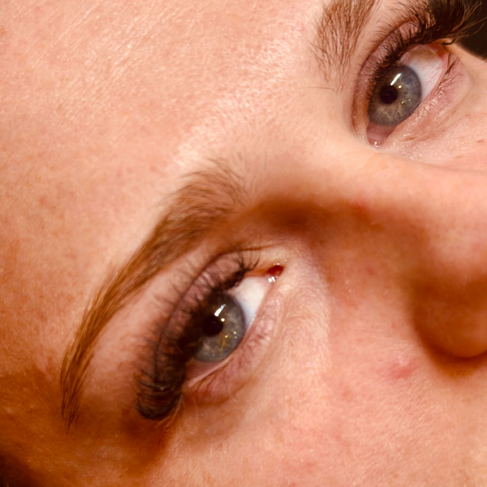 Volume Fill at Kolbi Fougerousse Esthetics in Dugger, IN