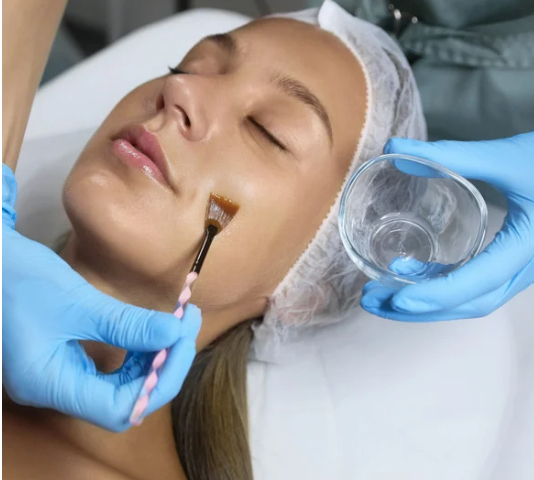 Chemical Peel