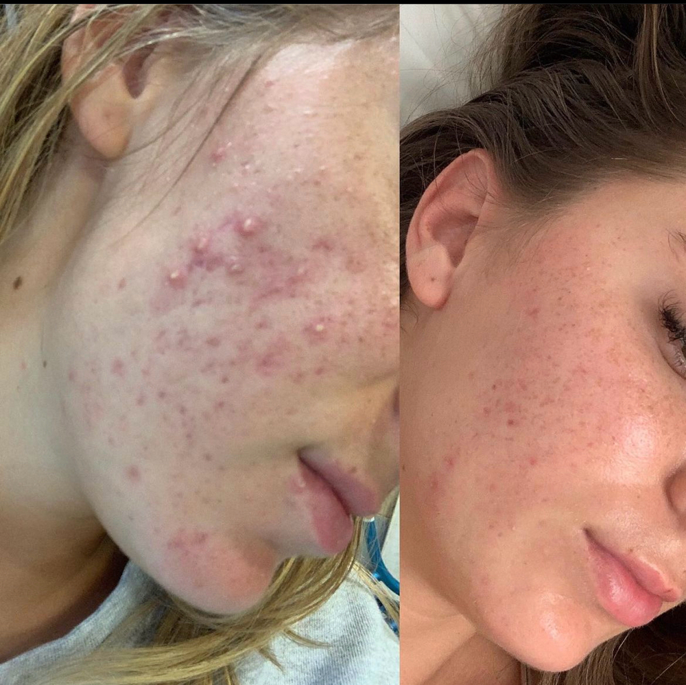 Acne Clearing Facial (New Client)