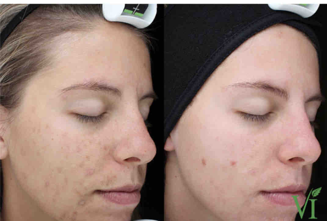 VI Chemical Peel