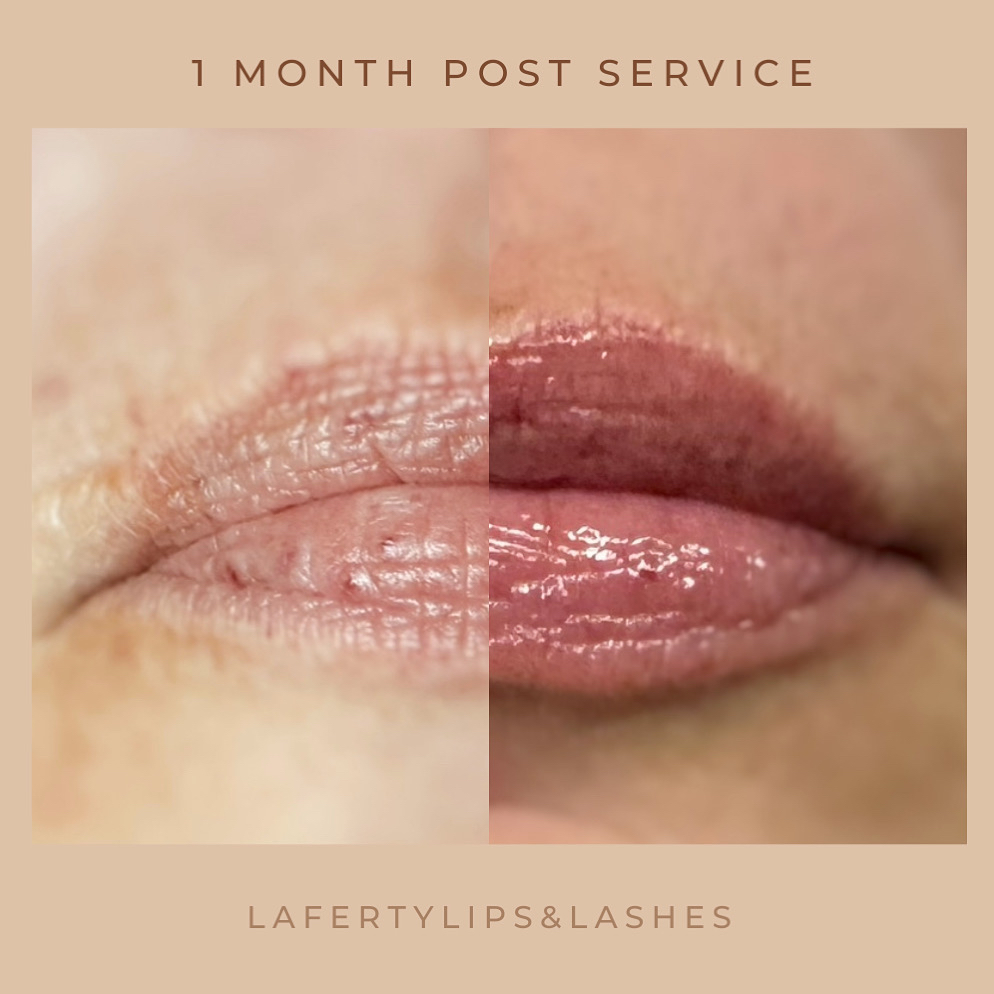 1.5ml Lip Filler