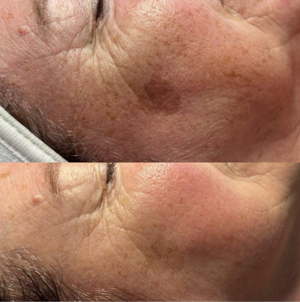 Brown Spots & Sun Damage Treatment at Skin 4 Glow Inc in MOHEGAN LAKE, NY