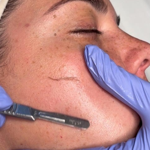 Dermaplane Upgrade at The Skin Concierge in Northbrook, IL