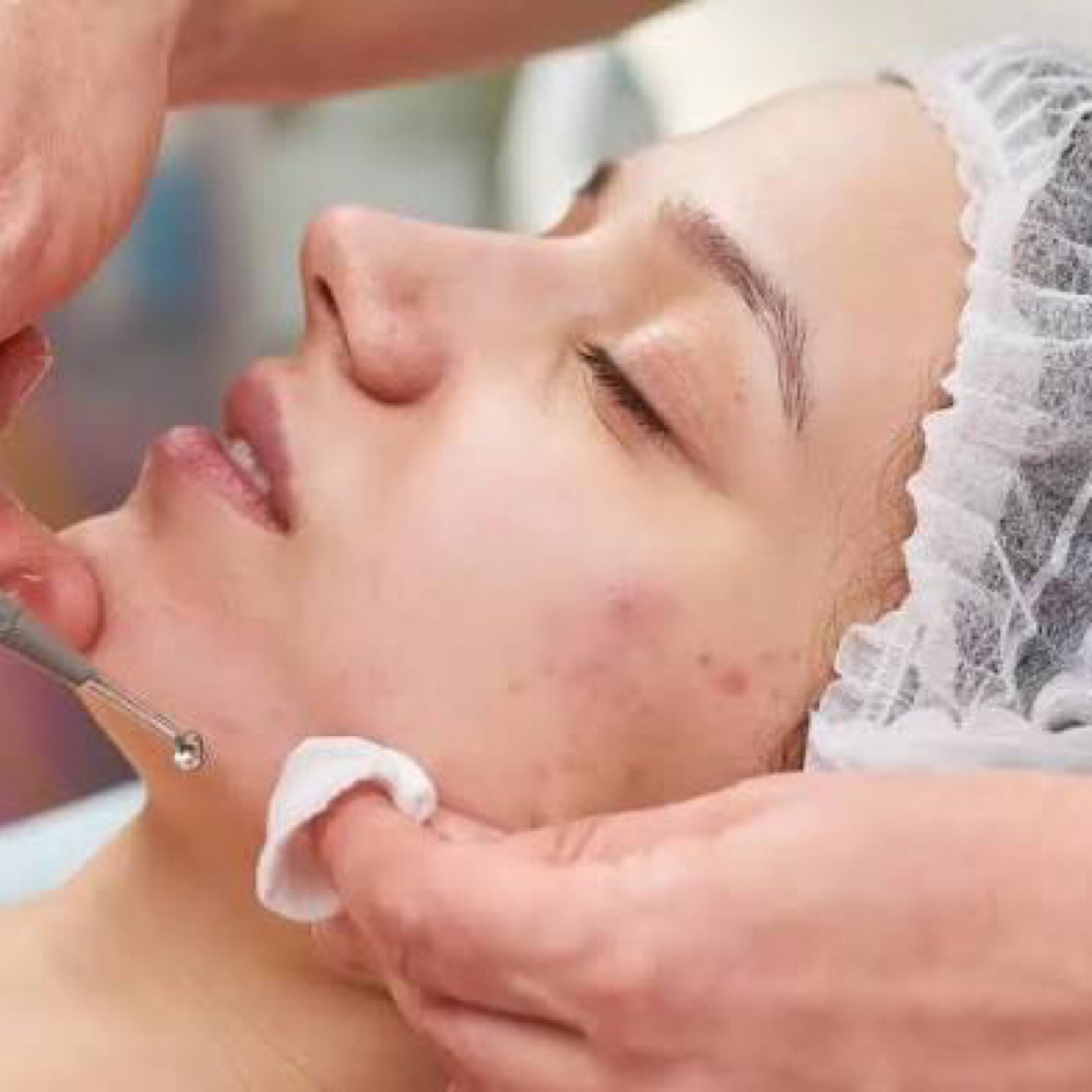 Anti - Acne Facial at KB Esthetic Spa Inc. in Dalton, GA