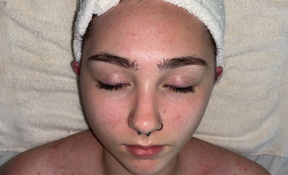 Teen Facial
