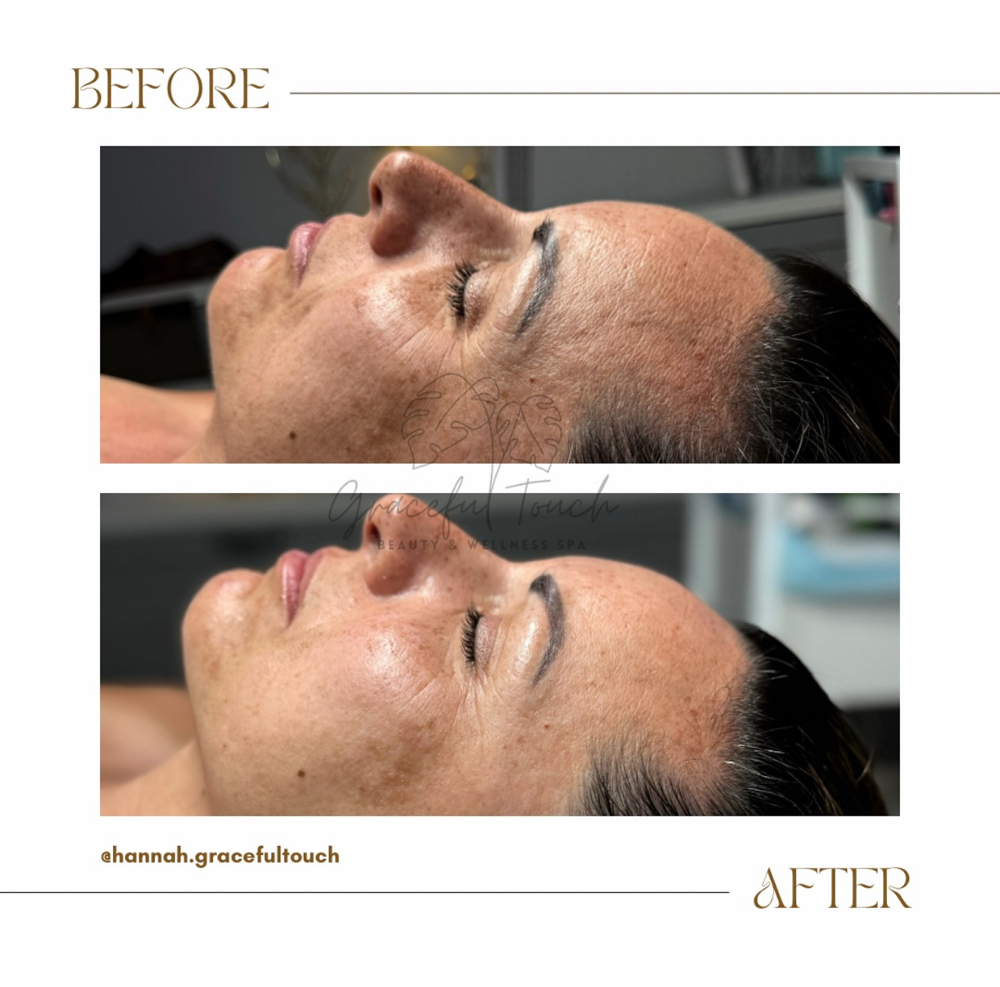 Graceful Radiance Melasma Facial