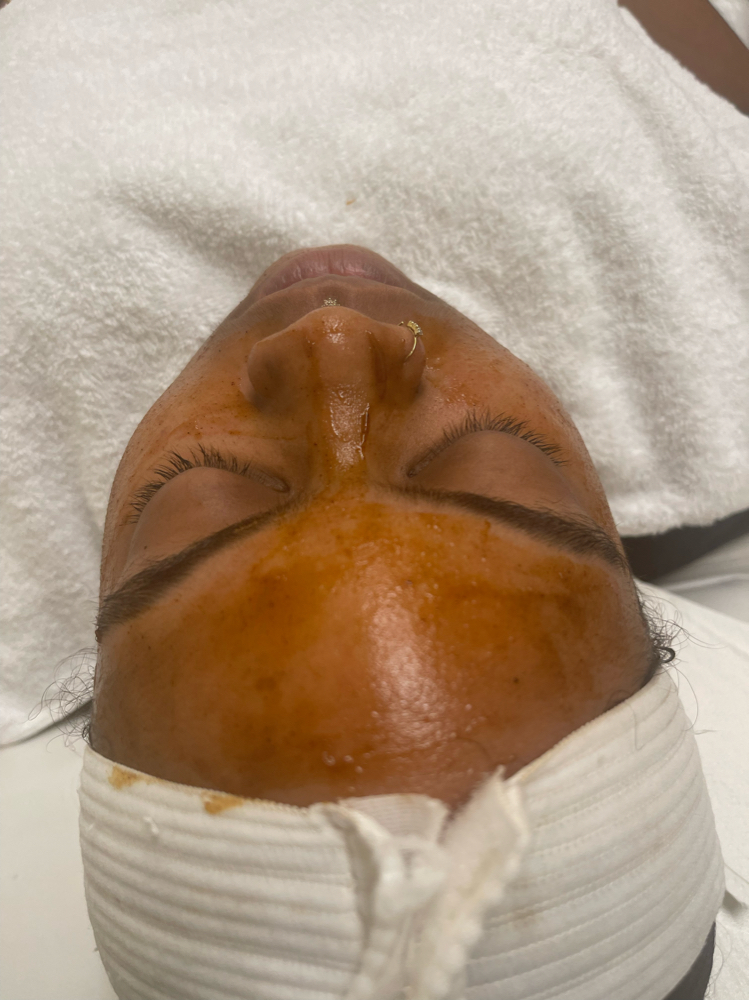 Chemical Peels at Haven of Beauty in Kennesaw, GA