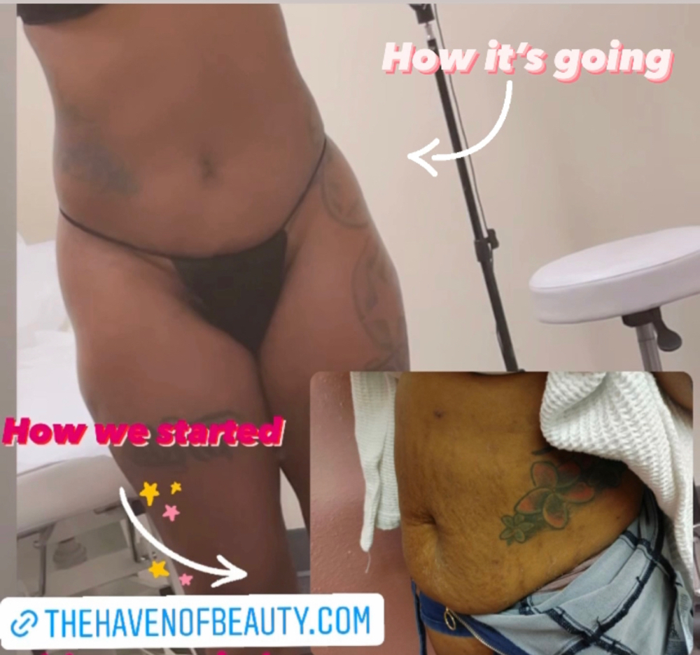 Body Sculpting at Haven of Beauty in Kennesaw, GA