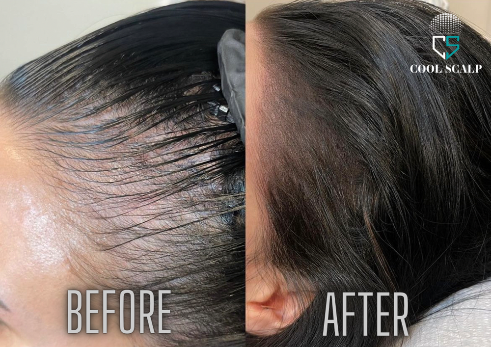 Scalp Micropigmentation For Women