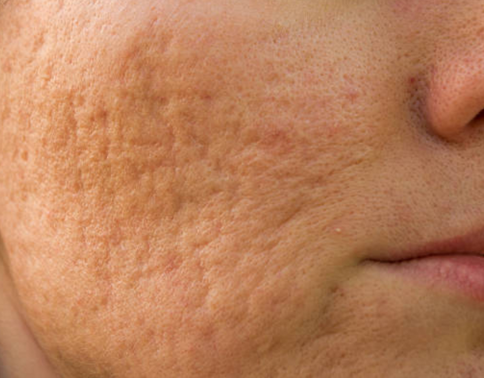 Spot Plasma at Signature Skin Spa in Scottsdale, AZ