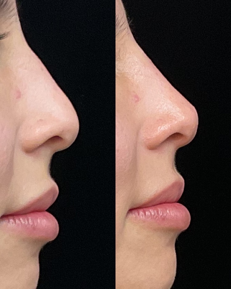 Liquid Rhinoplasty (Nose Filler)