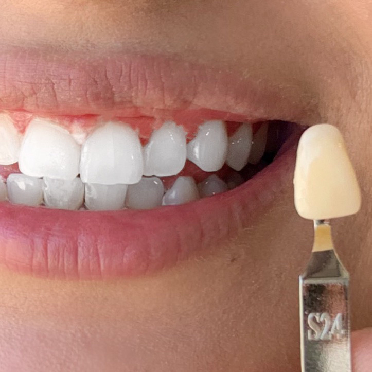 Teeth Whitening