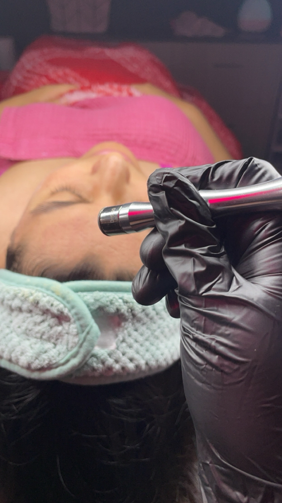 Microdermabrasion Facial