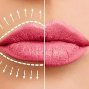 B. T. S. Versa Lip Filler at Be Beautiful Esthetics in Cleburne, TX