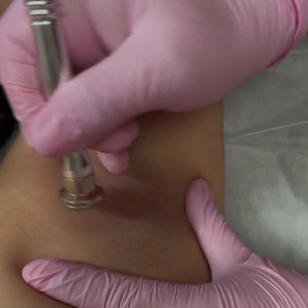 Hyperpigmentation Treatment at True Beauty Esthetics LLC in Palmview, TX