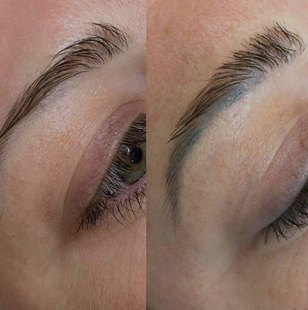 Saline Tattoo Removal
