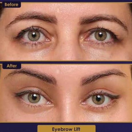 Tox Brow Lift at Ultimate Health Spa in Leesburg, FL