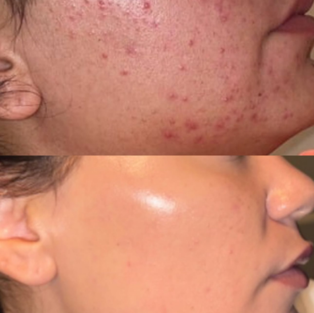 First Time Chemical Peel at Lane Luxury Esthetics in Bartlesville, OK
