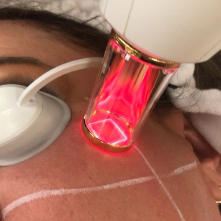 RINOVARE FRAXEL LASER at Lavana by Remake in Edinburg, TX