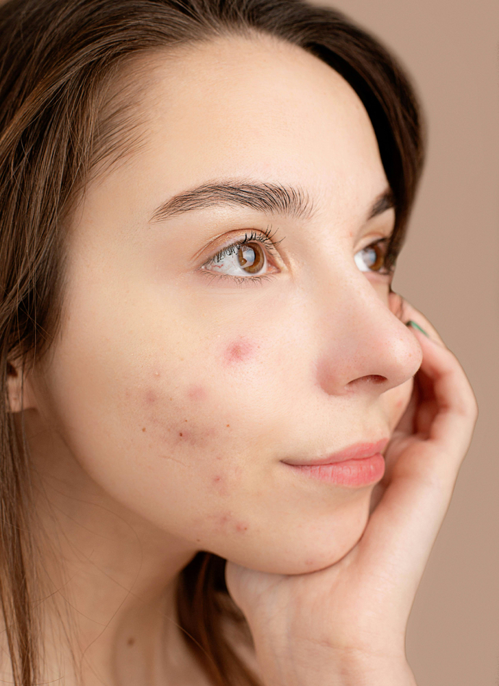 Acnic Skin Subscription Consult
