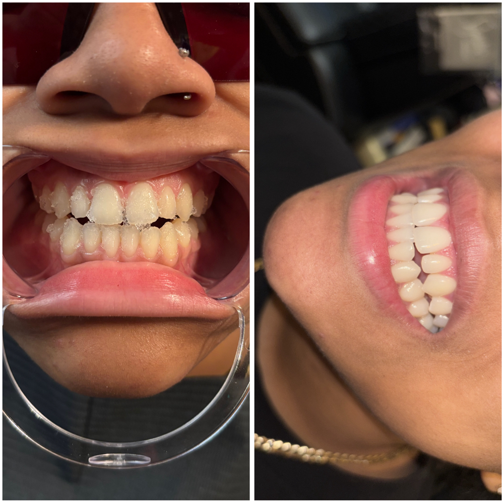Teeth Whitening