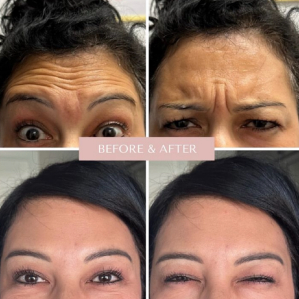 Botox – New Client (June Skin) at Eternal Glow Med Spa in Waddell, AZ