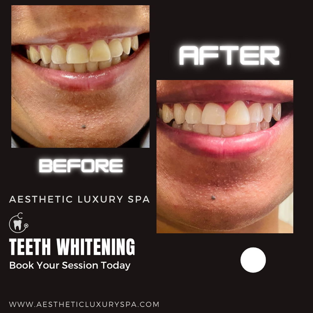 Advanced Teeth Whitening 16%