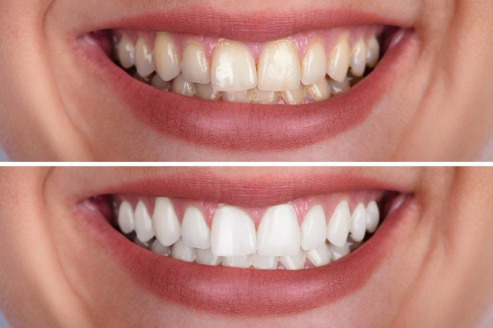 Advanced Teeth Whitening 16%