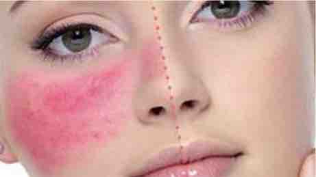 Tratamiento Rosacea