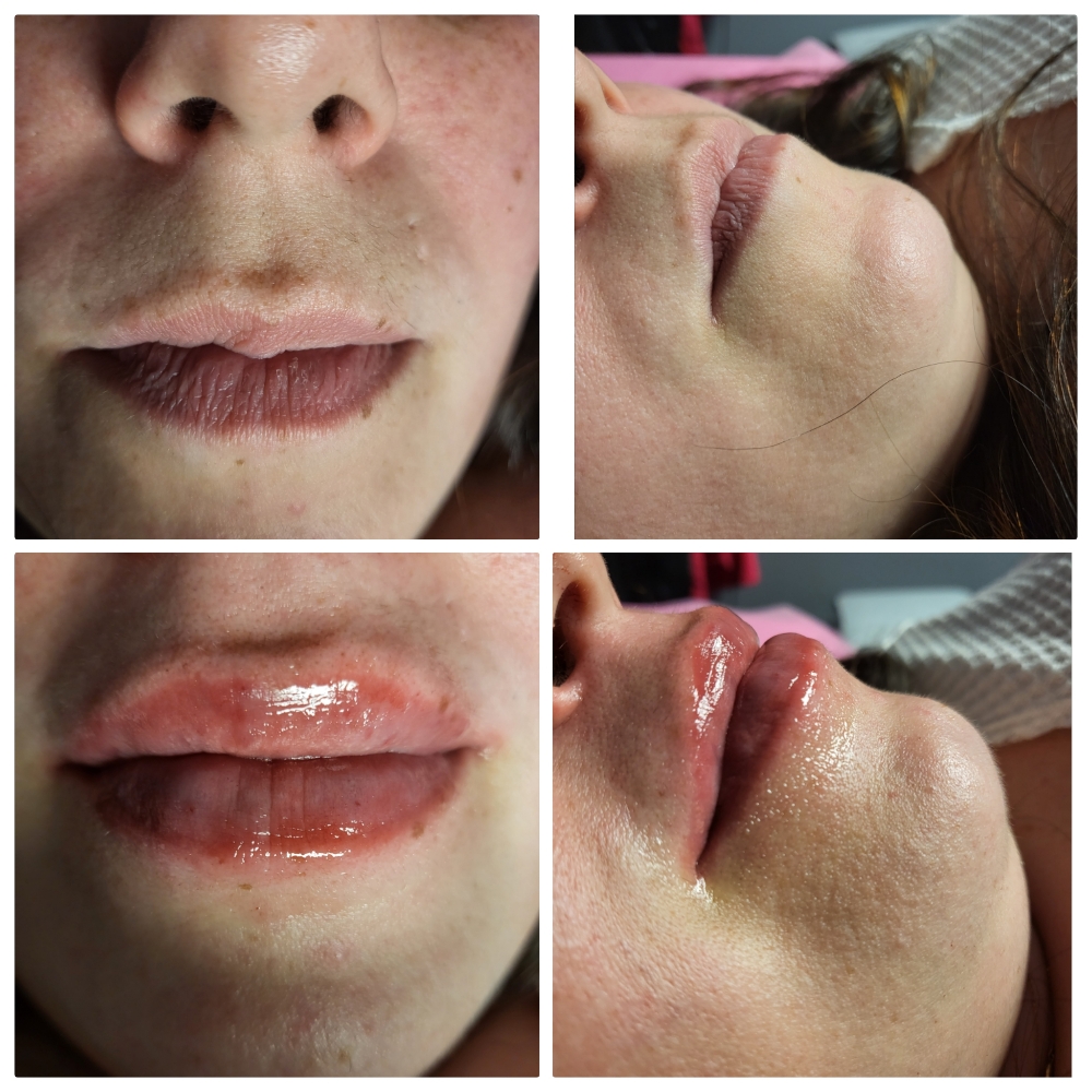 Needle Free Lip Filler