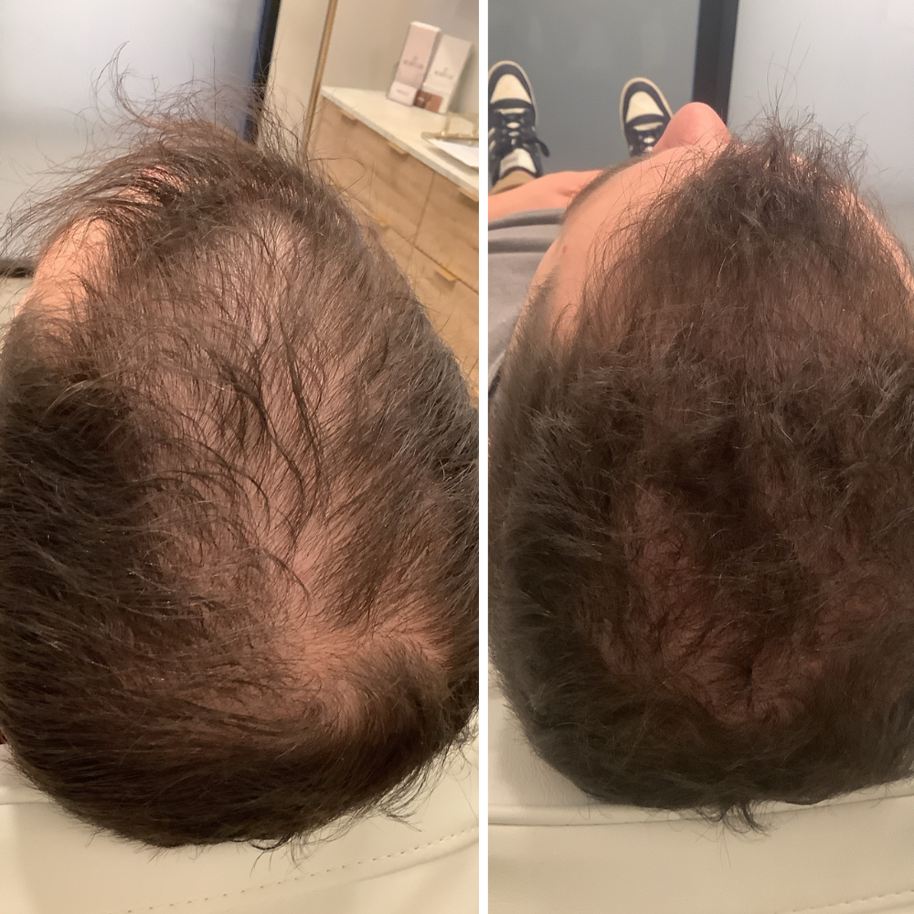 Hair Restoration