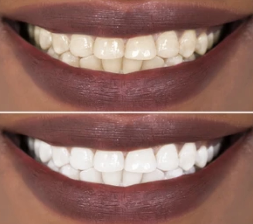 30 Min Custom Whitening