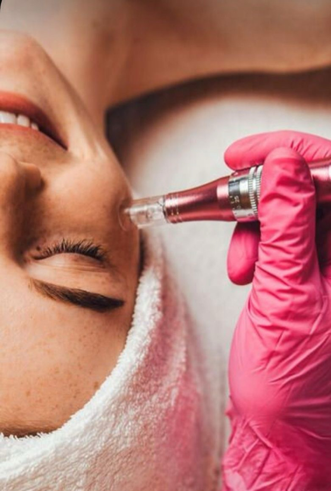 Add-on: Microneedling at Appalachian Beauty in Marion, NC