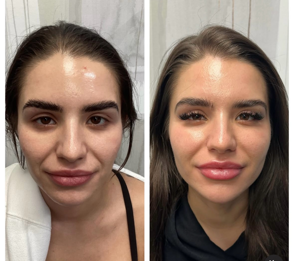 Cheek Or Chin Filler