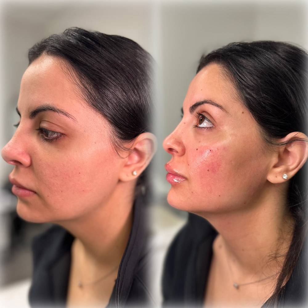 1 Syringe Juvederm (Face)