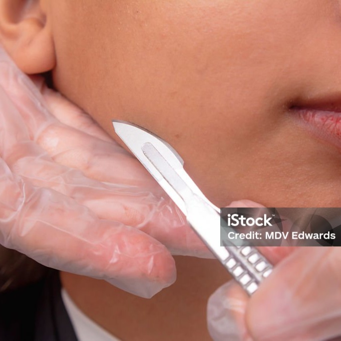Dermaplaning at Ana Hassan in Sacramento, CA