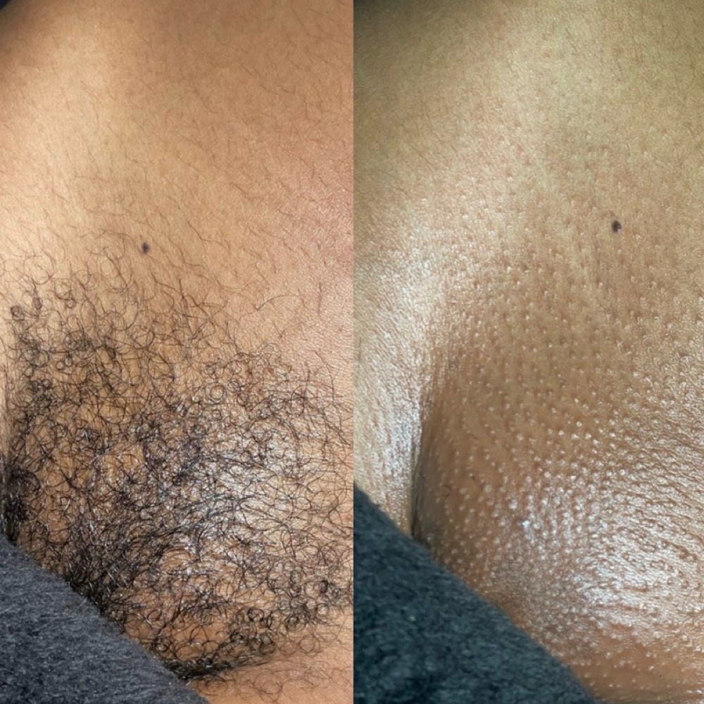 Brazilian Wax at Bare & Bloom Aesthetics Studio in Sugar Hill, GA