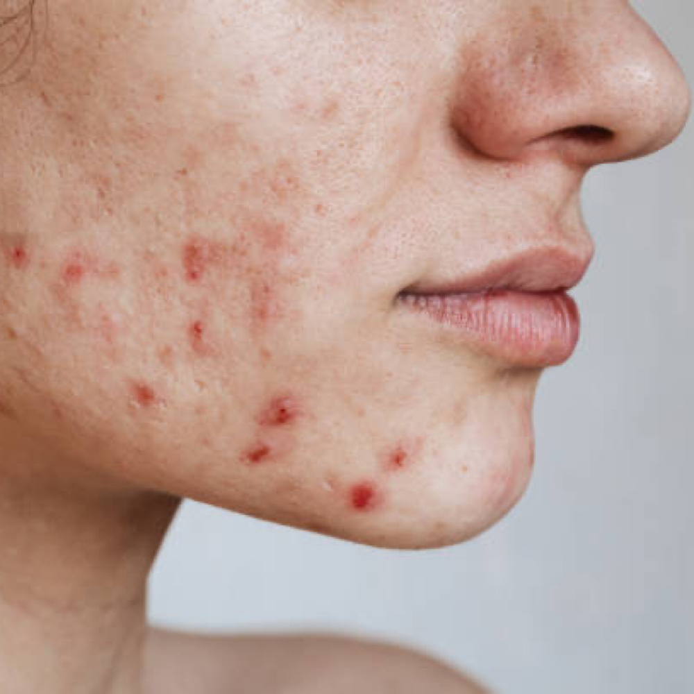 New Client Acne  Consultation at anasko skin studio in Dallas, TX