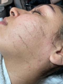 Dermaplaning Facial