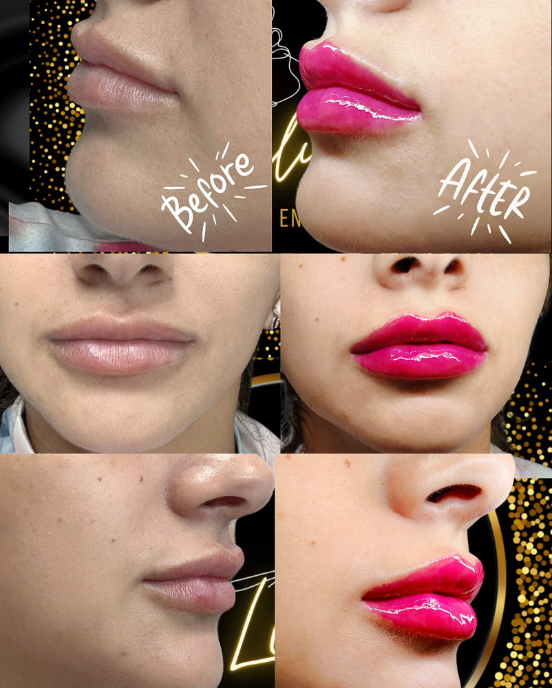 Revanesse Lips+